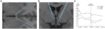 Tractography-based DBS lead repositioning improves outcome in refractory OCD and depression